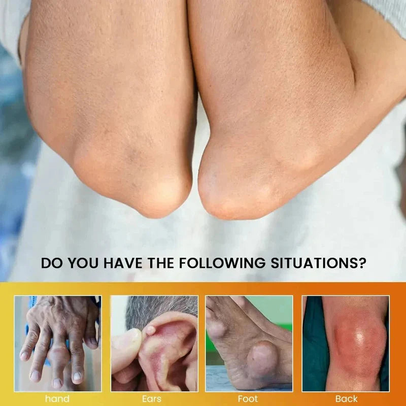 Sumifun Anti-Gout Cream โ Joint Pain Relief & Comfort Formula ๐ฟ